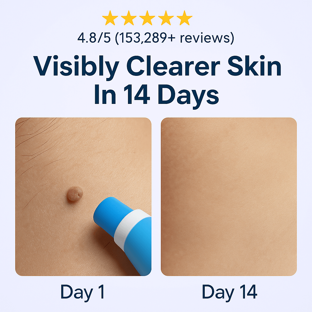 Skin Tag Remover